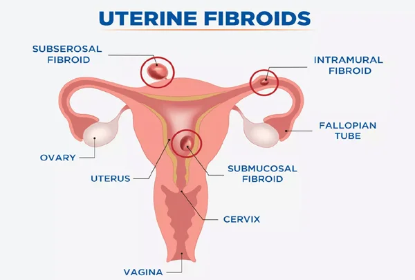 Uterine Fibroids