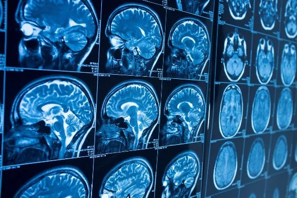 Neurological Problems