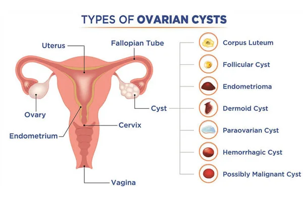 Ovarian Cysts